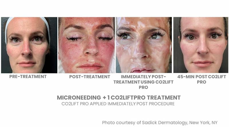 Miami Microneedling with PRF before and after, microneeding plus coliftpro treatment colift pro applied immediately post procedure