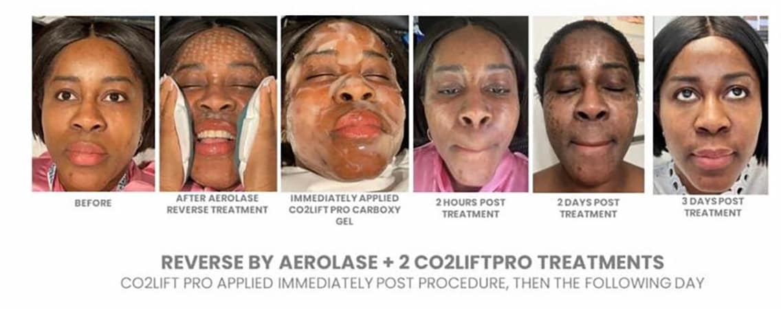 Miami Microneedling with PRF before and after - reverse by aerolase + 2 coliftpro treatments, colift pro applied immediately post procedure, then the following day