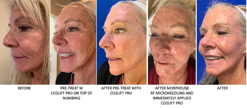 Miami Microneedling with PRF before and after - cozlift pro plus morpheus8 rf microneedling