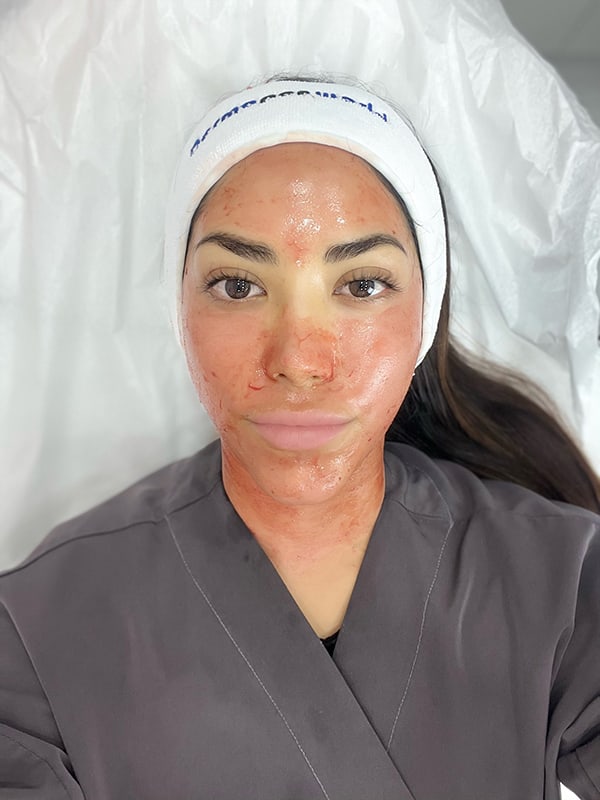 Microneedling with PRF Miami | AM Beauty & Wellness