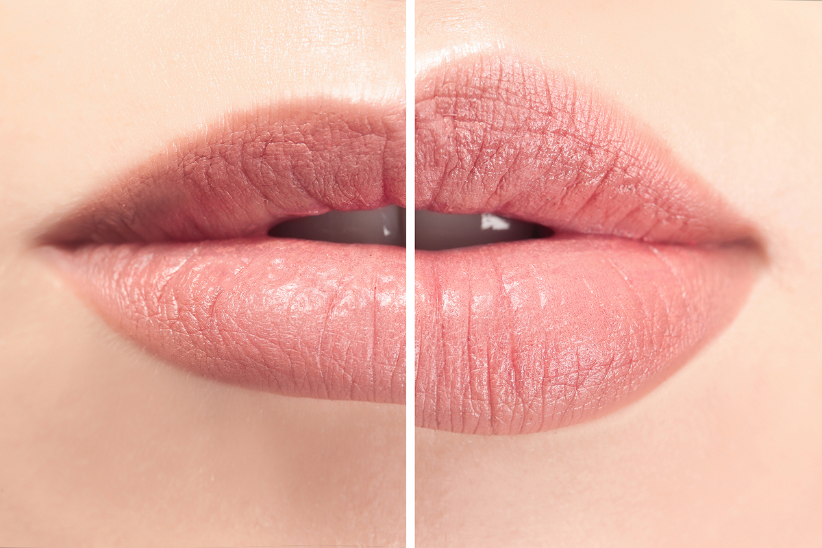 Close-up of lips showing before and after swelling from lip filler treatment, highlighting natural results