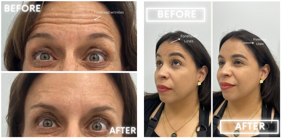 Before and after images showing reduced forehead wrinkles and elevated brow position from Botox brow lift treatment.