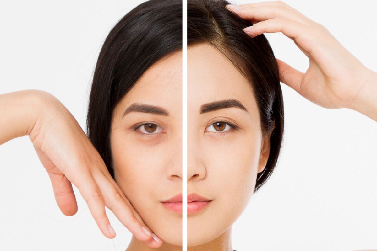 Side-by-side comparison of a woman's face before and after Botox brow lift showing lifted brows and smoother skin.