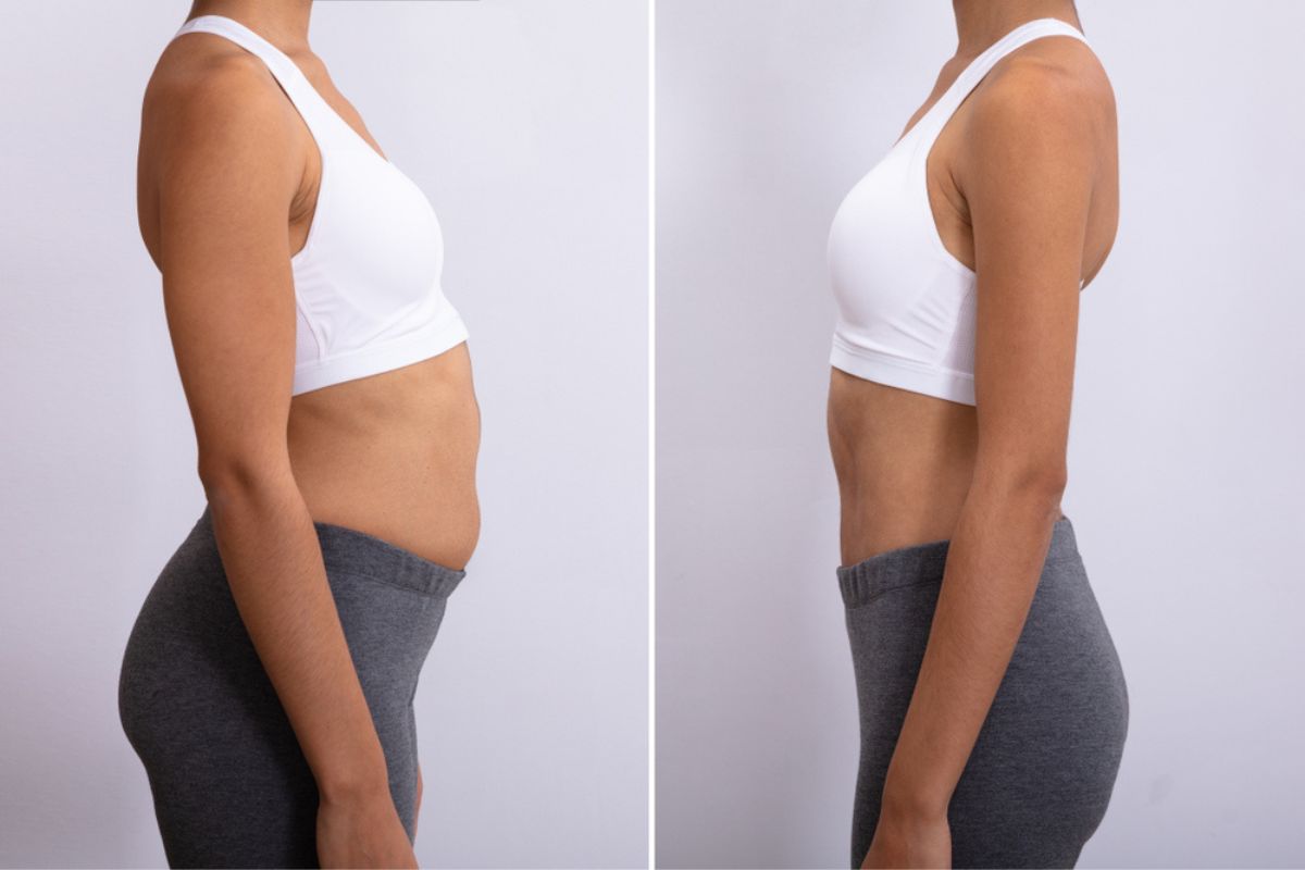 Side-by-side comparison of a woman�s abdomen before and after Emsculpt Neo treatment showing fat reduction and muscle tone.