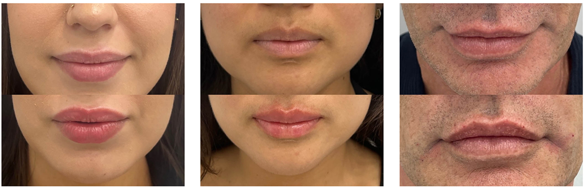 Before and after images showing reduced forehead wrinkles and elevated brow position from Botox brow lift treatment.