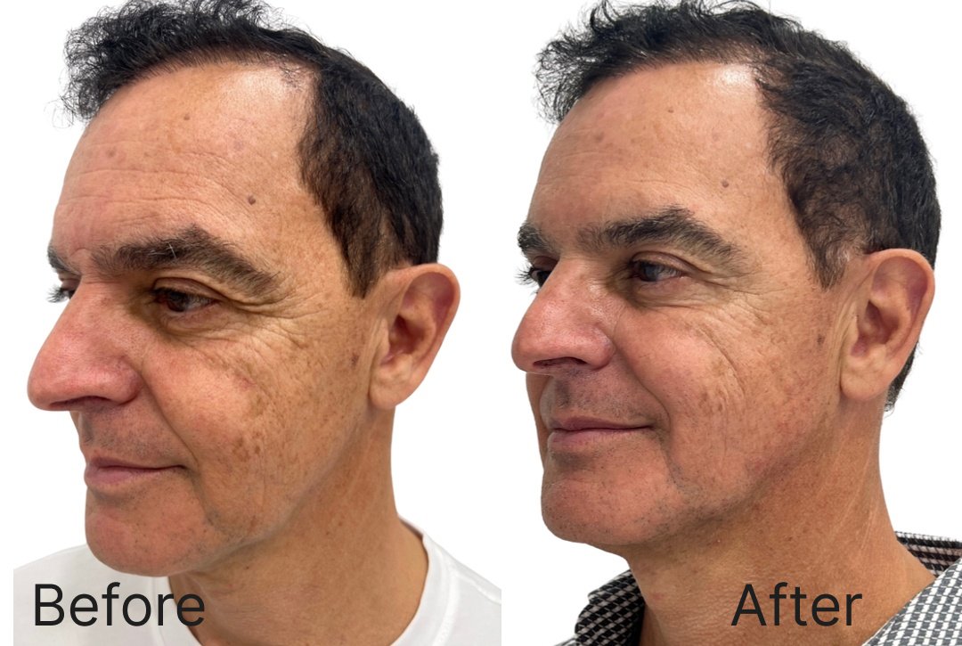 Botox Before & After Image