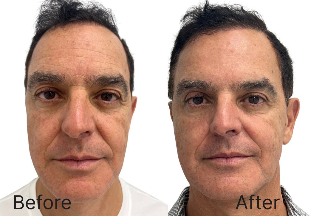 Botox Before & After Image