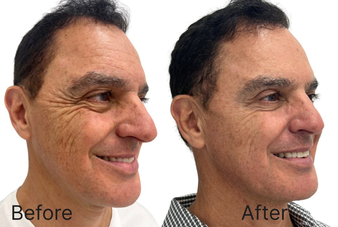 Botox Before & After Image