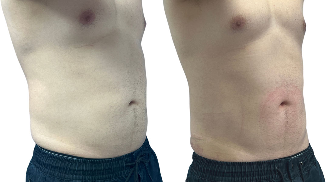 EMSculpt NEO Before & After Image