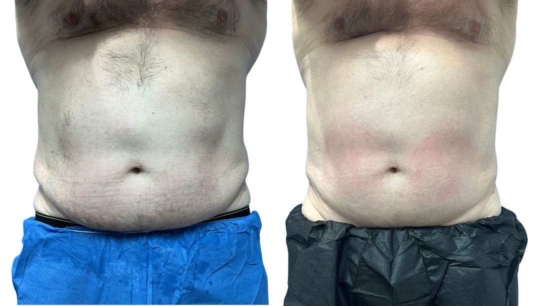 EMSculpt NEO Before & After Image