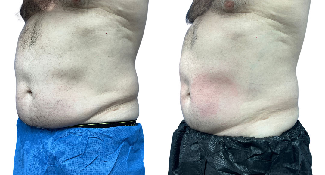 EMSculpt NEO Before & After Image