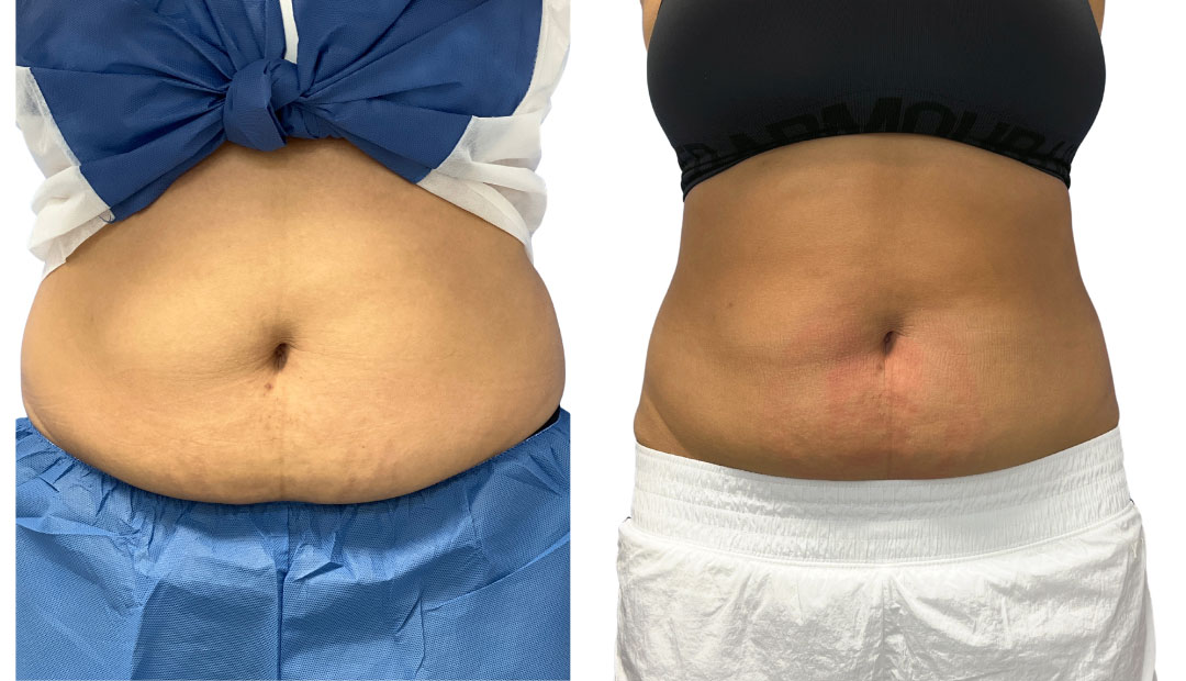 EMSculpt NEO Before & After Image