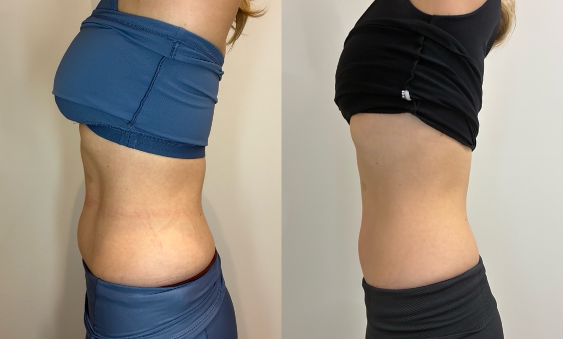 EMSculpt NEO Before & After Image