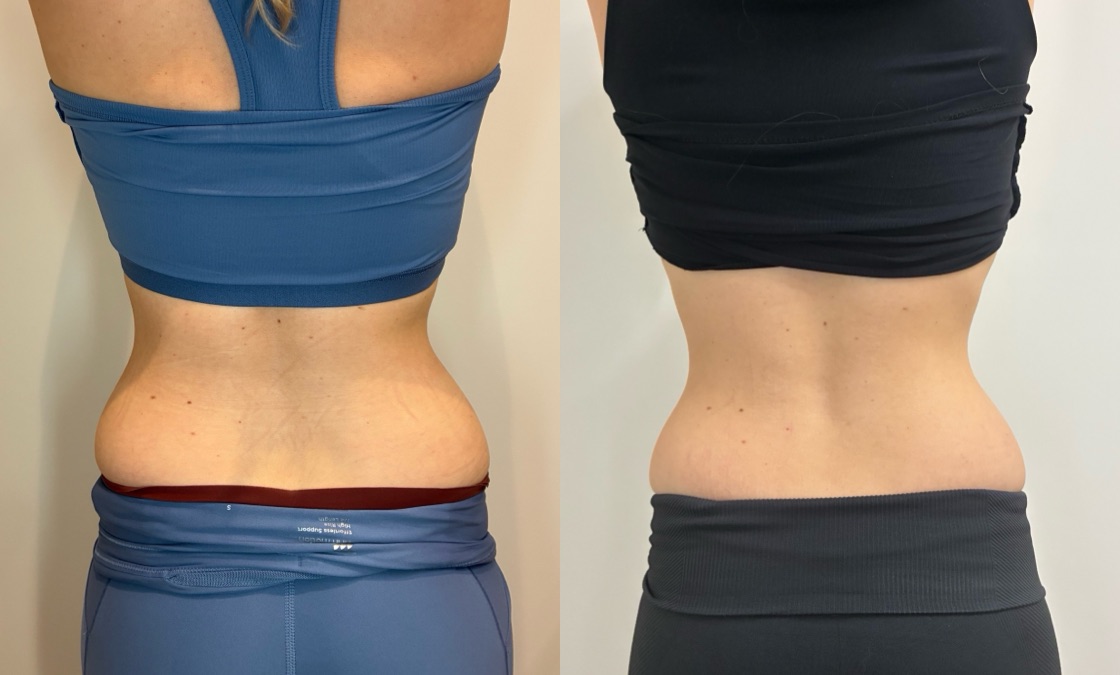 EMSculpt NEO Before & After Image