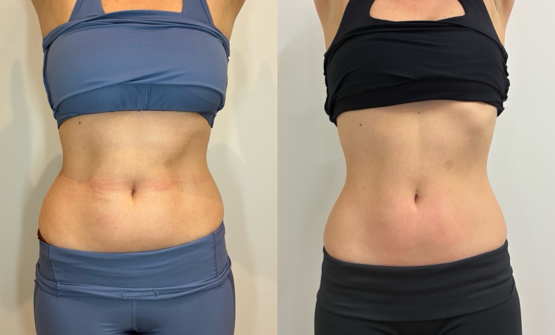 EMSculpt NEO Before & After Image