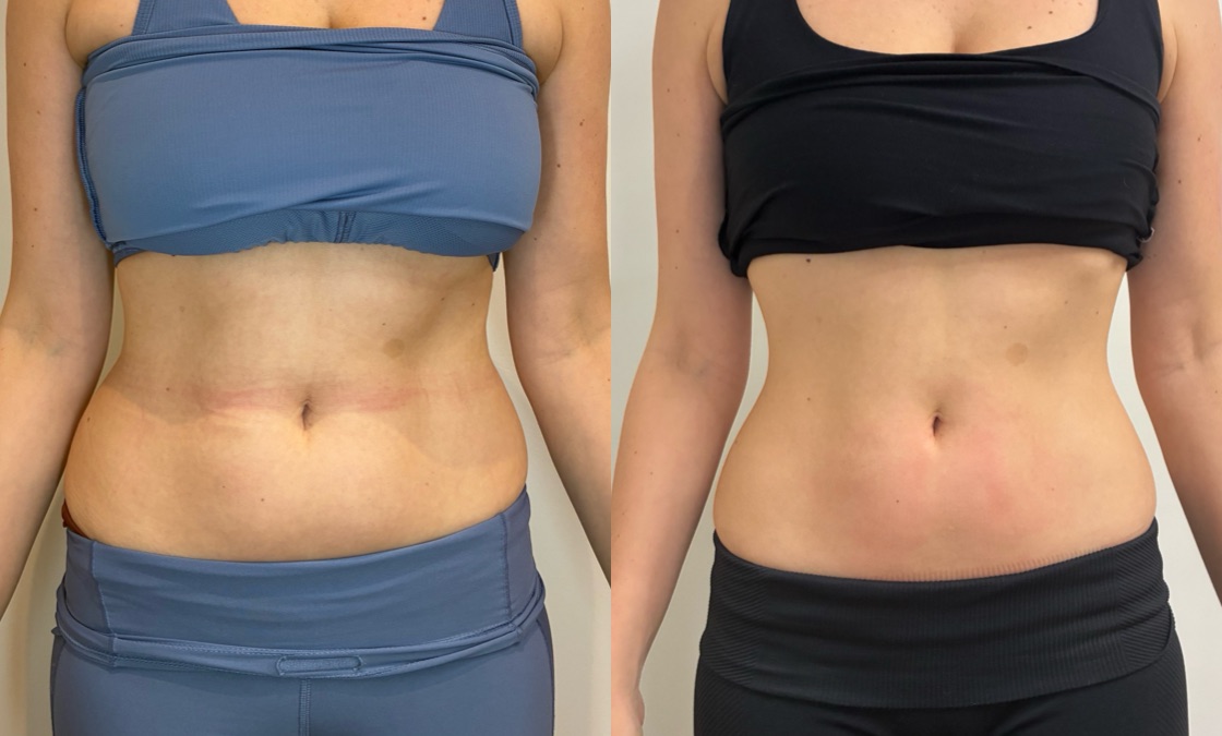 EMSculpt NEO Before & After Image