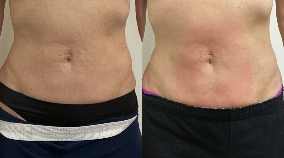 EMSculpt NEO Before & After Image