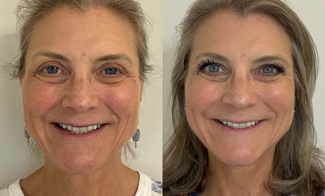 Facial Balancing Before & After Image