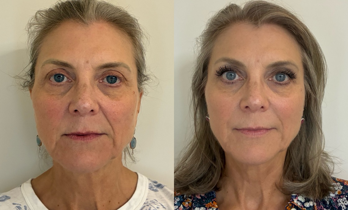 Facial Balancing Before & After Image