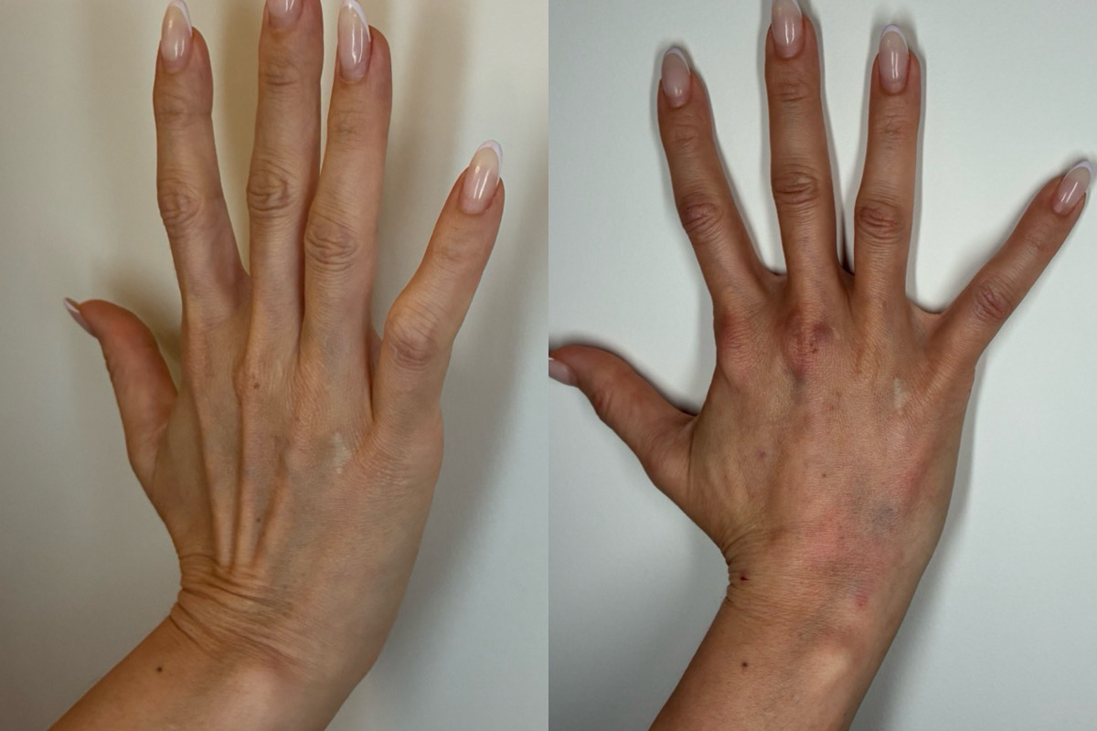 Fillers Before & After Image
