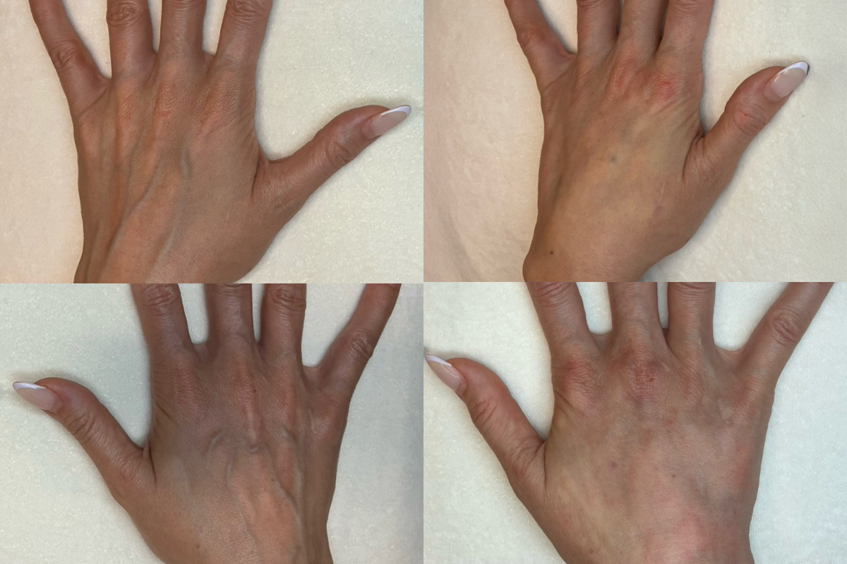 Fillers Before & After Image