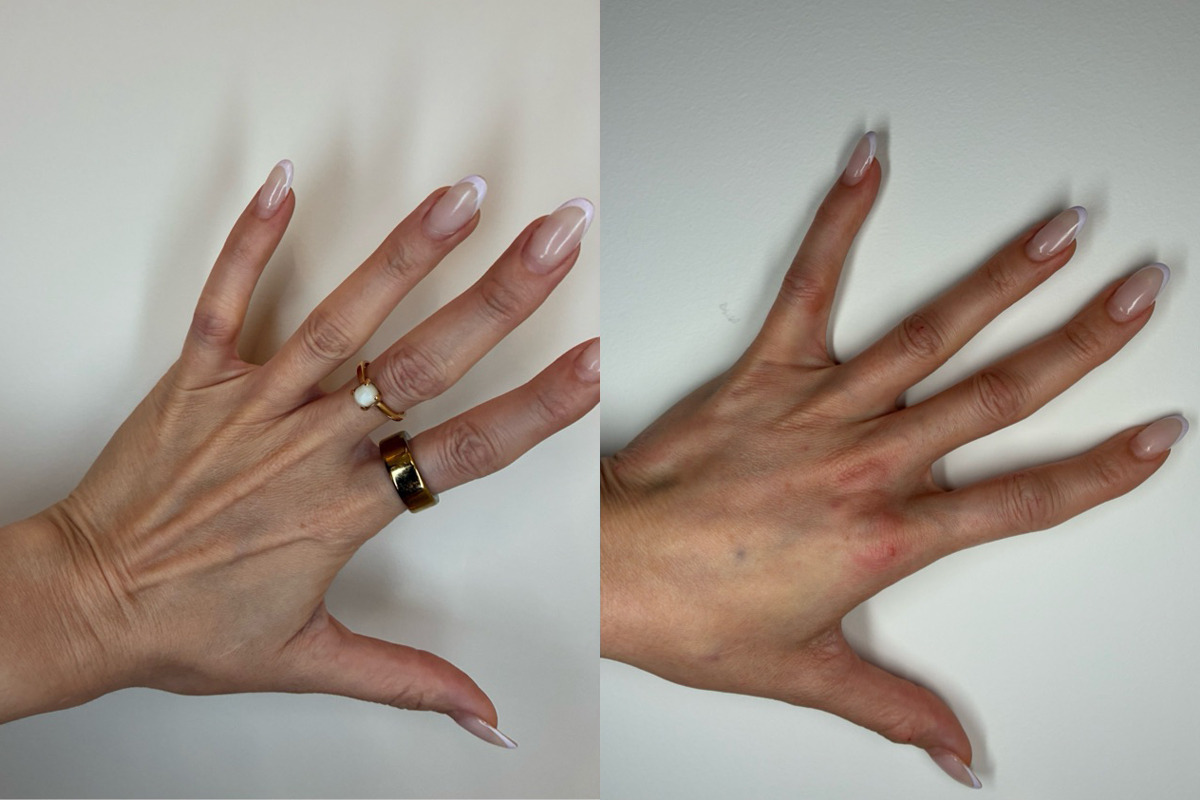 Fillers Before & After Image