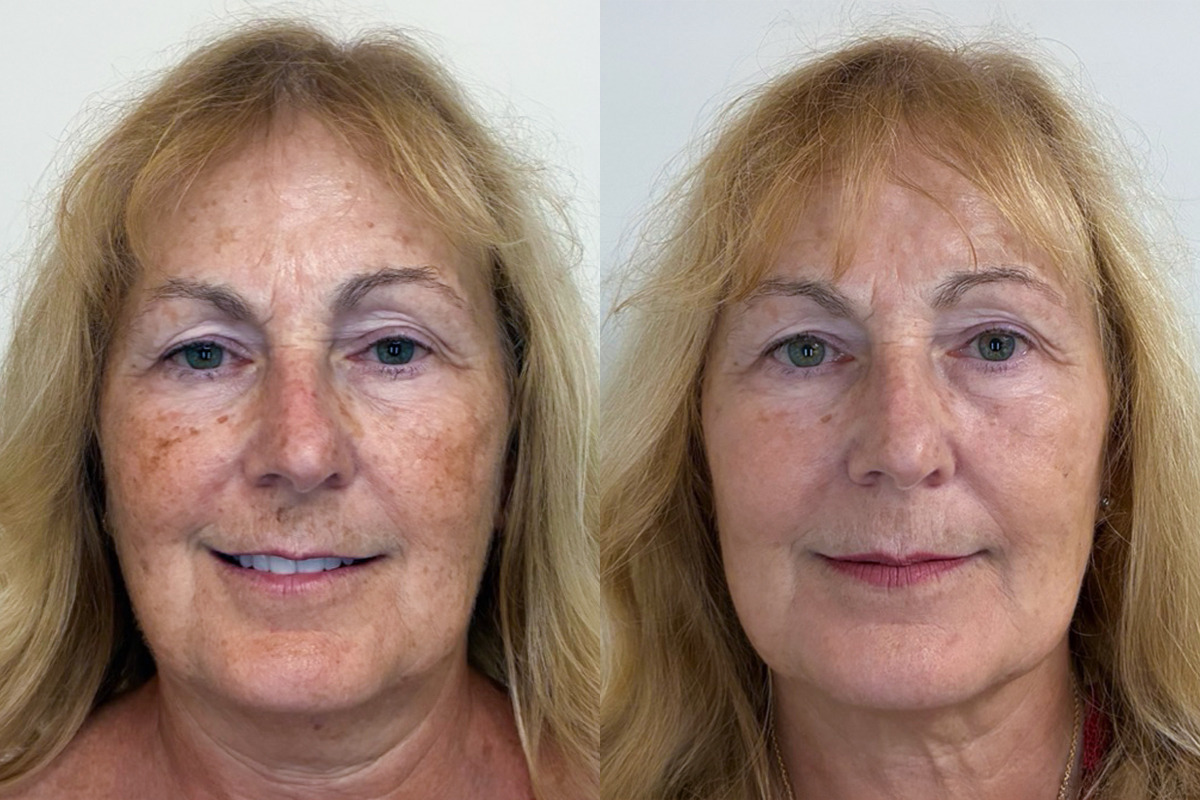 IPL Treatment Before & After Image