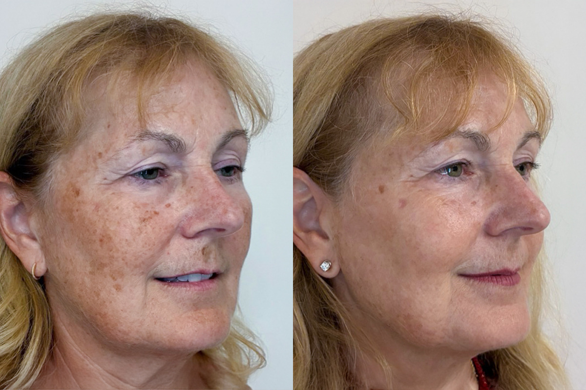 IPL Treatment Before & After Image