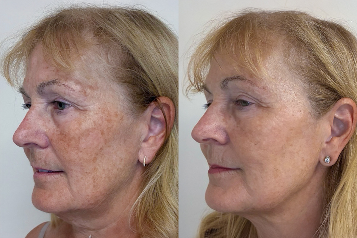 IPL Treatment Before & After Image