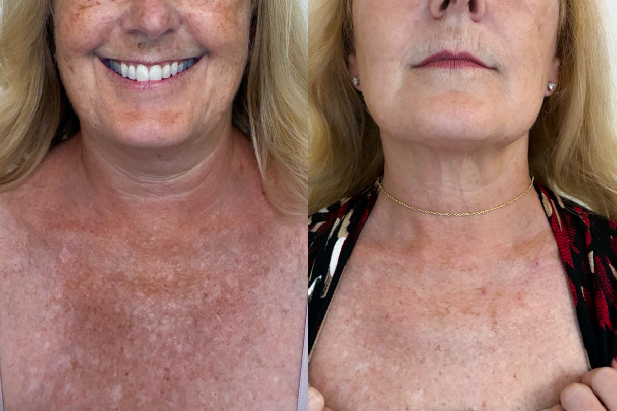 IPL Treatment Before & After Image