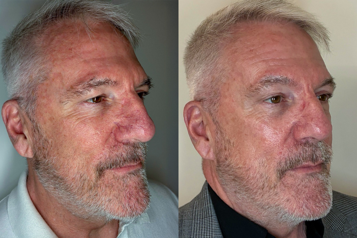 IPL Treatment Before & After Image