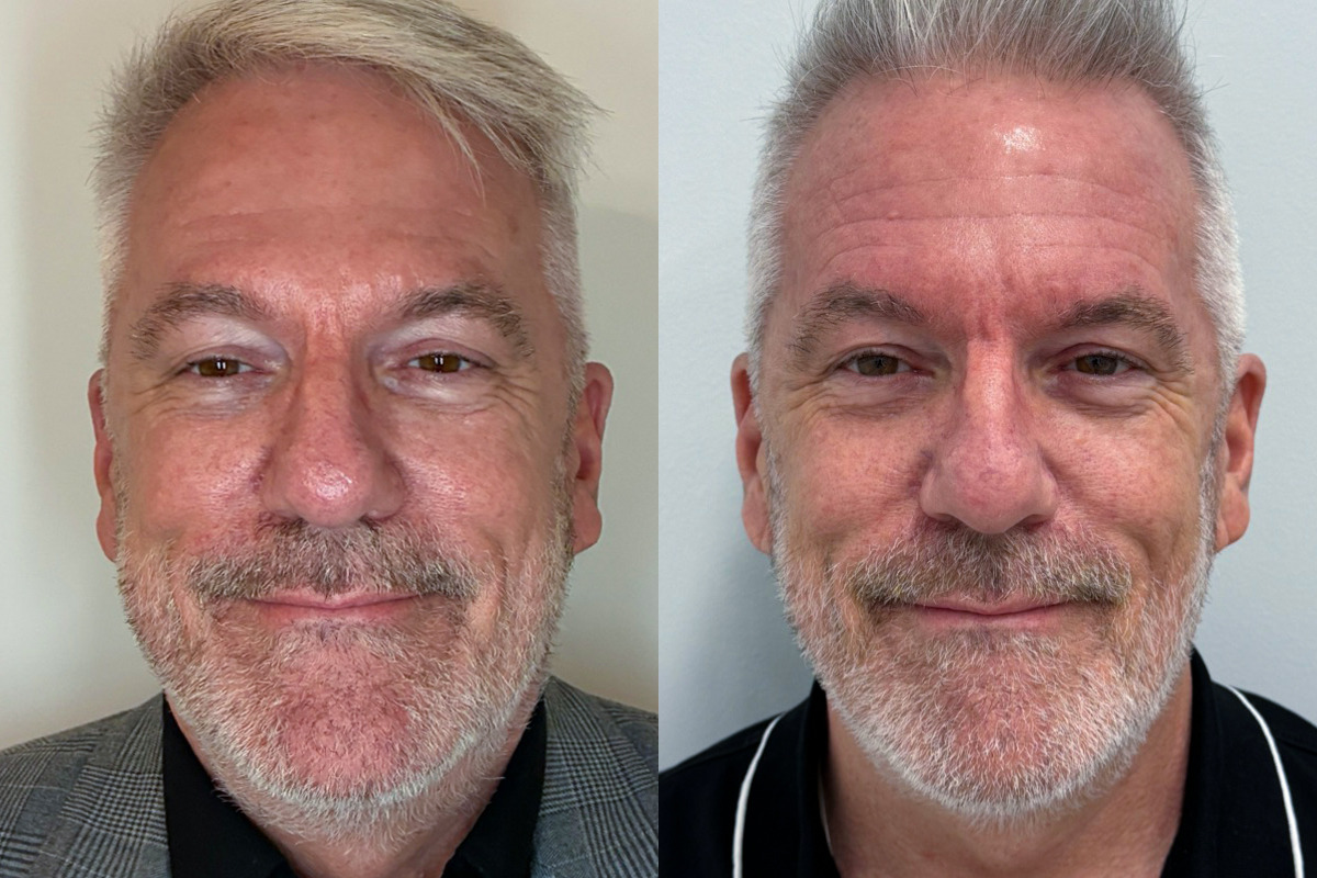 IPL Treatment Before & After Image