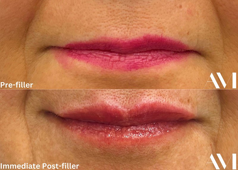 Lip Fillers Before & After Image