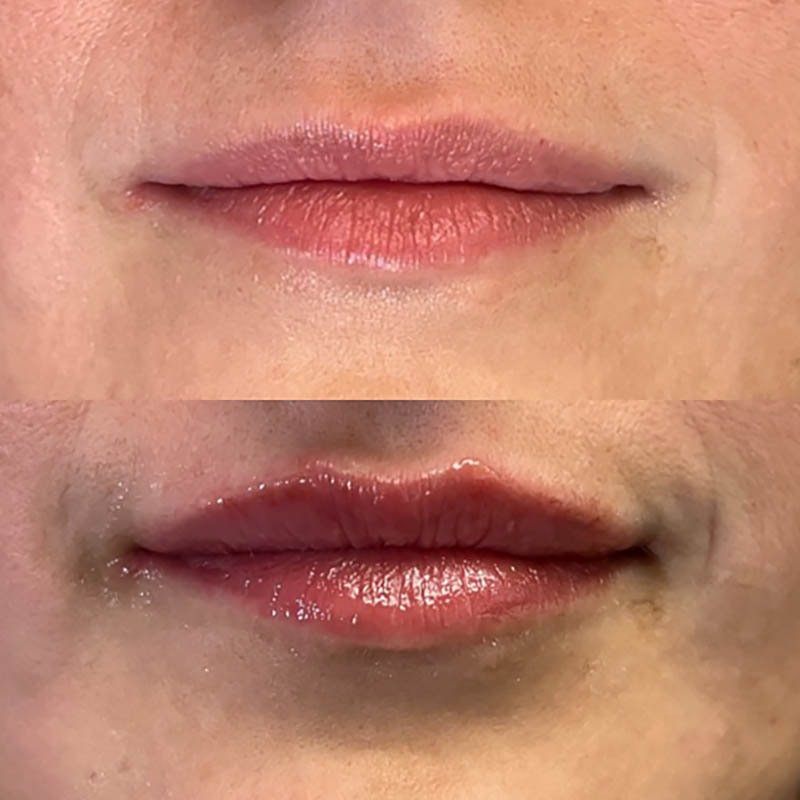 Lip Fillers Before & After Image