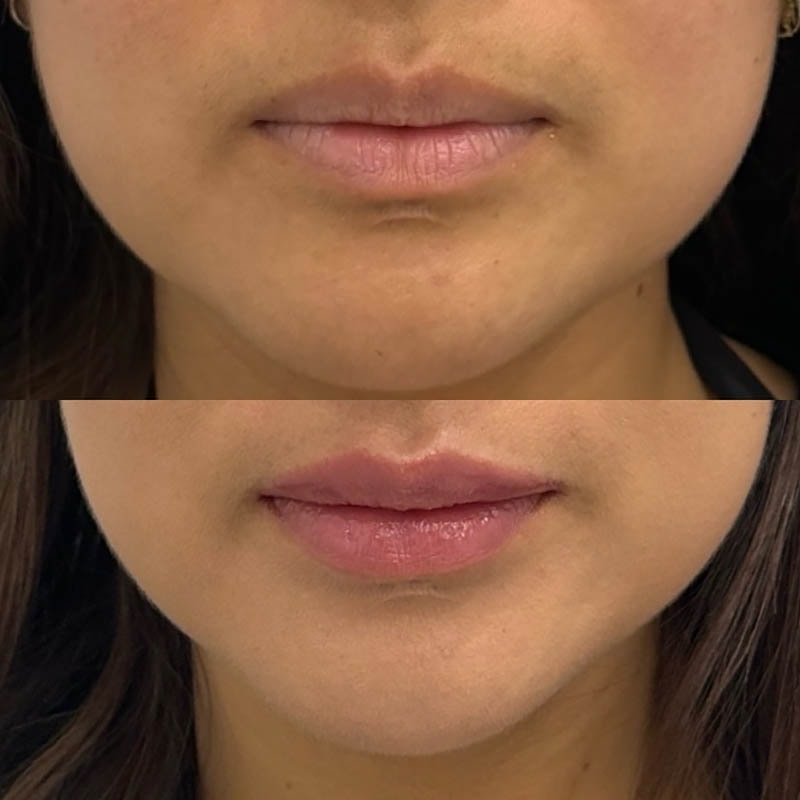 Lip Fillers Before & After Image