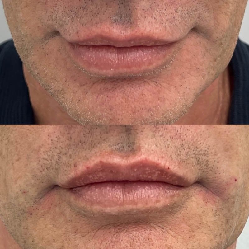 Lip Fillers Before & After Image