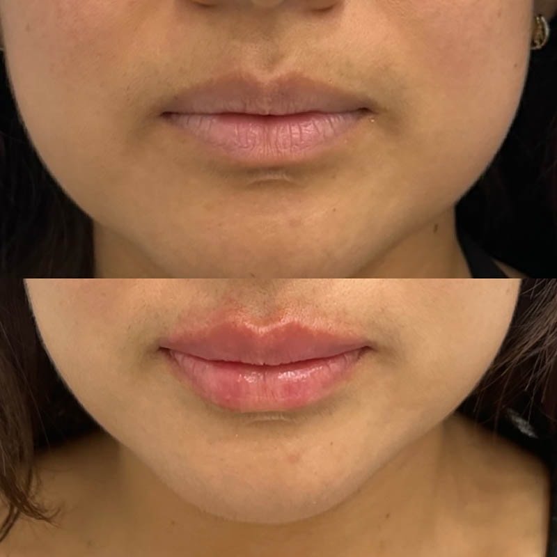 Lip Fillers Before & After Image