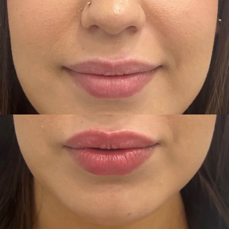 Lip Fillers Before & After Image