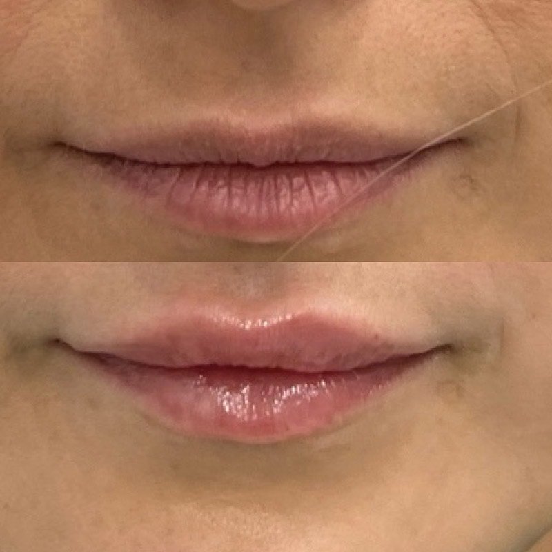 Lip Fillers Before & After Image