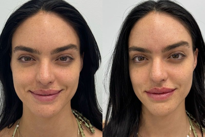 Lip Fillers Before & After Image