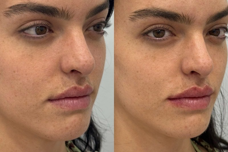 Lip Fillers Before & After Image