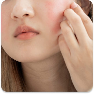 Acne Scars