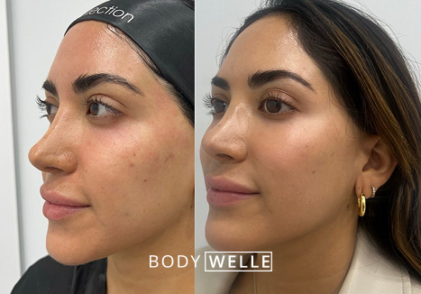 Before & After Microneedling