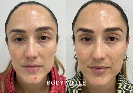 Before & After Microneedling