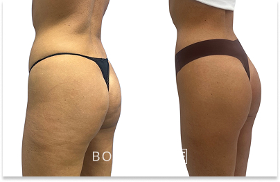 Before & After Emsculpt