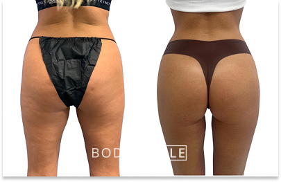 Before & After Emsculpt