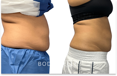 Before & After Emsculpt