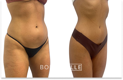 Before & After Emsculpt