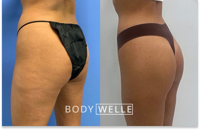 Before & After Emsculpt