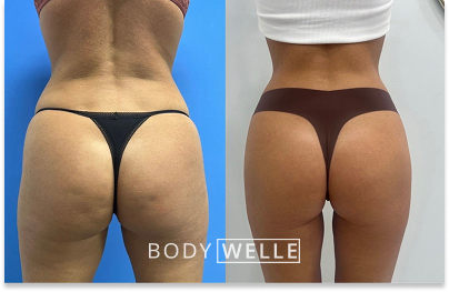 Before & After Emsculpt